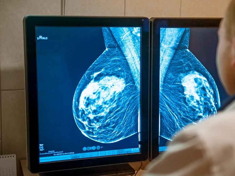 mamografi
